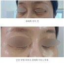 아이멍 | 인천 부평 피부과 쥬베룩 아이 눈밑꺼짐 붓기 멍 2주차 후기