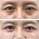 옳은손성형외과 네이버블로그