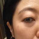 김포 피부과 흑자제거1탄