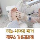 발가락 티눈 사마귀 제거, 레푸스 김포걸포점 후기