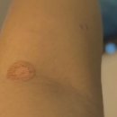 세화약국 | 세화병원 난자 채취 후, 시험관 배아이식