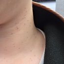 화접몽한의원 | 강남 화접몽 한의원 편평사마귀 300개 제거 후기