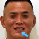 동원치과기공소 | 전체 임플란트 수술, 전후 및 후기. 뼈이식 동반 (상악동 거상술 및 치조골 확장술)