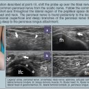 근골격계sono자료 Peroneal nerve 이미지