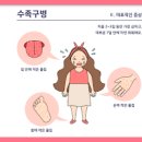 엔테로바이러스 장바이러스고열 발진 구내염 장염 폐렴 수족구병 이미지