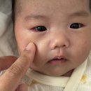이재백안과의원 | [육아 일기] 1~2개월 아기 다래끼, 병원 3곳 치료(소아과,소아안과),온찜질,항생제,안연고