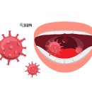 입냄새 구취 원인 대처법 이미지