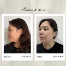 2454 | 이중턱 관리 7일 후기 (비포애프터 공개) 온스에스테틱 천안본점 돌준맘 리얼 후기