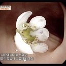 대장내시경을 하다 발견된 대장 속 활짝 핀 꽃 이미지