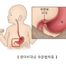 유문 | 신생아 유문협착증 진단/수술후기(대전 건양대병원)
