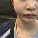 럭키치과의원 | 두근두근 3n살의 마지막 사랑니 발치 후기 | 인천 사랑니 공장 서울이턱사랑니치과의원