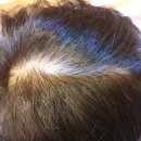 보라매동-19 | 20대 남성, 한달에 한번하는 다운펌, 정수리 탈모까지 된 이유는?