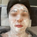 위풍당당한의원 | [내돈내산] 남자 얼굴/목 편평사마귀 제거 후기