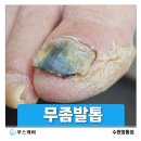 롯데하이마트(주)화성물류센터 | 수원 발톱무좀) 안전화를 오래 신으면 발톱도 변할까요?