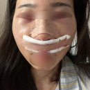 쉬어갑시다 | [내 돈 내산] 논현역 구축코 재수술 후기_자가늑+자가진피+실리콘(+2주 후기)