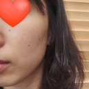 수정약국 | 수원 점빼기, 500원에 점 빼는곳 피부과 추천 (내돈내산)