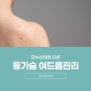 새곡지 | 회현 가슴 여드름, 모공각화증과 어떻게 구분할 수 있을까요?