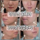 11305-8-300-1 | 강남역 울쎄라 300샷 내돈내산 8일차 후기 : 턱라인 리프팅 효과와 솔직한 단점 정리