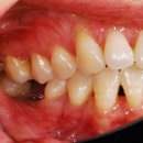 굿데이기공소 | 수면마취치과) 아스트라 당일임플란트 식립케이스 (39세여성)