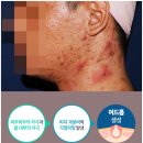 노아한의원 | 강남여드름피부과 한의원 병변 발병 원인 분석하여