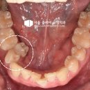 서울클리어치과교정과치과의원 | [길음동 교정치과] 안쪽으로 숨은 심한 덧니, 클리피씨 발치 교정 및 충치 치료 병행 사례
