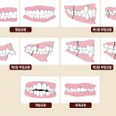 괴로운 볼씹힘 원인 부정교합 때문일까 (123급) 이미지