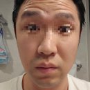 의사 본인이 직접 맞은 이마 보톡스 후기 – 표정은 괜찮을까?