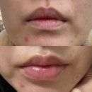 로데오로(2) | 압구정로데오 피부과 비대칭 입술필러 쥬비덤 후기