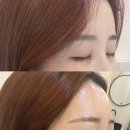 압구정-259 | 수영구 피부관리 플랜비 에스테틱｜연어앰플 MTS, 물방울리프팅 후기