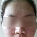비로소봄 | 골드 ptt 효과와 부작용 둘다 경험해봄 (후기)