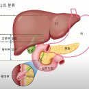 [의사가 말하는 담도암-2편]간외담도암, 어떻게 치료하나요?(간문부 담도암, 원위부 담도암) 이미지