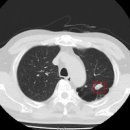 폐암의 경고 신호? 폐결절 증상 및 원인과 치료 방법 고립성 폐결절 이미지