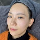 채운 | 울트라콜 200으로 눈밑 볼륨 채운 찐 후기 + 가격