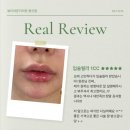 김지은피부과의원 | 신용산역 피부과 입술 filler 전 고려해야 할 것들