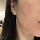 [내돈내산] 셀인샷 EGF 알란테놀 리페어 크림+클린업더마 AC B6 스팟 솔루션 일주일 사용후기 (임산부...
