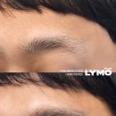 라이모플러스(LYMOPLUS) 이미지