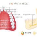 제3대구치(사랑니)에 대한 치아치료(보험금을 지급하지 않는 사유) 이미지