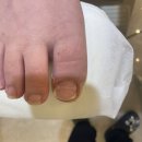 레푸스 평택점 | 레푸스 평택역점 방문기 – 꼼꼼한 관리로 평택내성발톱 통증에서 해방!