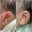 연세똘똘이소아청소년과의원 | 베이비이어 신생아 귀교정 후기 (연세수소아청소년과의원) 15개월 현재사진 첨부