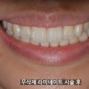 치아 라미네이트 단점 보완 무삭제 시술방법 (앞니, 가격) 이미지