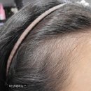 마샬헤어라인 이미지