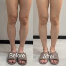 365테라피 | 대전 다이어트 관리 [아나덴 둔산점] 에서 하체 슬리핑테라피 받은 후기