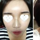 에스탑성형피부 네이버블로그