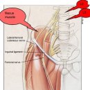 meralgia paresthetica 이미지