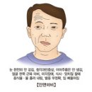 안면마비 다른이름 구안와사, 안면신경마비, 얼굴마비, 와사풍 이미지