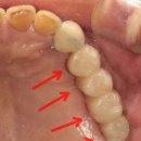 좋은솜씨죽전치과의원 | 좋은솜씨죽전치과 임플란트가 흔들리기 시작한다면? 주위염의 위험성부터 사후 관리의 중요성에 대한...