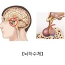 뇌하수체 종양 및 (선종, ) 이미지