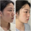 피부과 / 리프팅으로 효과 보고 싶을때 같이 하면 좋은 볼뉴머(300샷)+슈링크(300샷) 볼링크 시술 후기