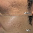 새힘한의원 | 창원여드름흉터 새살침 후기 | 내돈내산 창원한의원 패인 자국 치료