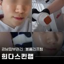 광선메디칼 | 팔자주름 옅어지고 피부톤까지 밝아진 볼륨리프팅 : 강남피부관리 희다스킨랩